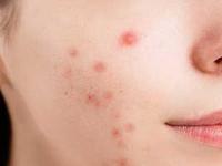 पिंपल्स वाढल्याने चेहरा खराब दिसतो? फक्त ५ गोष्टी सांभाळा, काही दिवसांतच पिंपल्स गायब - Marathi News | 5 tips for pimple free skin, how to get rid of pimples, home hacks for reducing pimples | Latest sakhi Photos at Lokmat.com