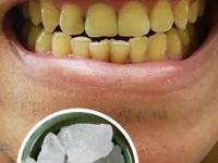 फक्त १० रुपये खर्च करा, पिवळसर दात पांढरेशुभ्र होऊन चमकतील-दातांची काळजी घ्या - Marathi News | how to get rid of yellow teeth, best home hacks to reduce cavity, how to get relief from toothaches? | Latest sakhi Photos at Lokmat.com