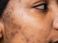 जायफळाचं होममेड क्रिम, रोज रात्री चेहऱ्याला लावा- त्वचेवर एकही डाग राहणार नाही, सौंदर्य खुलतच जाईल - Marathi News | home made jayfal or nutmeg cream for glowing skin, how to remove dark spots, pigmentation using nutmeg or jayfal | Latest sakhi Photos at Lokmat.com