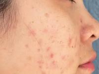 वांगाचे जुनाट डागही काही दिवसांतच होतील गायब! फक्त २ पदार्थ वापरा- चेहरा होईल नितळ, स्वच्छ - Marathi News | 2 simple tricks to get rid of pigmentation, how to remove pigmentation and dark spots | Latest sakhi Photos at Lokmat.com