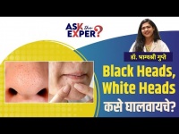 Black Heads - White Heads कसे दूर करावेत? | How To Remove Blackheads & Whiteheads | Ask the Expert