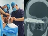 26 वर्षांआधी एकाने डोक्यात मारला होता चाकू; डॉक्टरांनी आता काढला, फोटो पाहून व्हाल थक्क... - Marathi News | 26 years ago he was stabbed doctor removes rusty knife from chinese mans head api | Latest jarahatke Photos at Lokmat.com