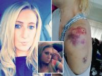 वाढदिवशी गर्लफ्रेंडला मारहाण, अंगावर कुत्रा सोडल्यानं ३० टाके; प्रियकराचं अमानुष कृत्य - Marathi News | Tinder date left ex scarred for life after setting dog on her in row on birthday kkg | Latest crime Photos at Lokmat.com