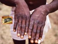 Monkeypox virus: मंकीपॉक्स म्हणजे काय? जाणून घ्या आजाराची लक्षणं - Marathi News | Monkeypox virus: What is a monkeypox? Know the symptoms of the disease | Latest health Photos at Lokmat.com