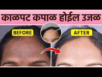 काळपट कपाळासाठी Serum | Serum for Forehead Pigmentation | Remedies For Dark Pigmentation