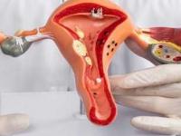 PCOS नाही, आता PMOS! ८ पैकी १ ‘या’ समस्येने त्रस्त; १७ कोटी महिलांच्या आरोग्यावर थेट परिणाम - Marathi News | PCOS Name Changed To PMOS: How This Impacts Women Globally And In India | Latest sakhi News at Lokmat.com