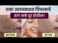 एका आठवड्यात पिंपल्सचे डाग कसे दूर होतील? | How To Get Rid Of Pimples | Home Remedies For Pimples