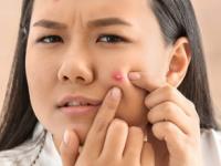 तुम्ही ‘हे’ पदार्थ रोज खाता, म्हणून चेहऱ्यावर येतात मुरुम-पुटकुळ्या-डागही जाता जात नाहीत - Marathi News | beauty tips avoid this food eating daily lifestyle increasing pimples acne pigmentation issue how clean and glowing skin care tips | Latest sakhi Photos at Lokmat.com