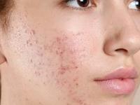 मुलतानी मातीत कालवून 'हा' पदार्थ चेहऱ्याला लावा! भरपूर पिंपल्स- पिगमेंटेशन-डाग होतील गायब - Marathi News | skin care tips add Multani mitti and camphor powder paste In face for acne free skin dark circle pigmentation issue | Latest sakhi Photos at Lokmat.com