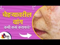 चेहऱ्यावरील वांग जाण्यासाठी घरगुती उपाय | Home Remedies for Pigmentation on Face | Lokmat Sakhi