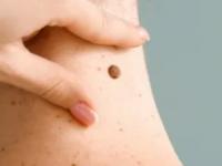 Health Tips: शरीरावर असलेले लाल तीळ कशाचे लक्षण? त्यात काही काळजीचे कारण असते की... - Marathi News | Health Tips: What is the sign of a red mole on the body? There are some reasons for concern... | Latest sakhi News at Lokmat.com Health Tips: शरीरावर असलेले लाल तीळ कशाचे लक्षण? त्यात काही काळजीचे कारण असते की... - Marathi News | Health Tips: What is the sign of a red mole on the body? There are some reasons for concern... | Latest sakhi News at Lokmat.com