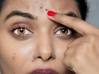 पिंपल्स-फोडांचे डाग जात नाहीत? रोज रात्री करा खास उपाय, चेहऱ्यावरील सुरकुत्या- मुरुमे होतील कमी - Marathi News | Pimple and acne marks not going away special remedy every night it will reduce facial wrinkles and pimples | Latest sakhi Photos at Lokmat.com