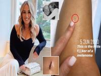 सौंदर्याची खूण वाटणारा तीळच तिला मृत्यूच्या दारात नेणार होता; पण नशीब बलवत्तर होतं म्हणून... - Marathi News | Woman Shares how beautiful new mole on leg was actually cancerous | Latest jarahatke Photos at Lokmat.com