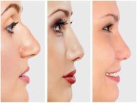 नाकाच्या आकारावरून जाणून घ्या तुमच्या पर्सनॅलिटीबाबत, वाचून व्हाल अवाक्! - Marathi News | Types of noses and what secrets they reveal about your personality | Latest jarahatke Photos at Lokmat.com