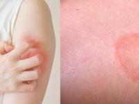 उन्हाळ्यात फंगल इन्फेक्शनच्या त्रासाने हैराण आहात? तर 'या' उपायांनी मिळवा त्रासापासून सुटका - Marathi News | Home remedies for fungal infection in summer myb | Latest health Photos at Lokmat.com