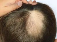 लहान मुलांचेही केस खूप गळतात? जावेद हबीब सांगतात मुलांच्या नाजुक केसांसाठी सोपा उपाय - Marathi News | how to reduce hair loss in kids, simple tips and tricks to control hair fall in kids by javed habib | Latest sakhi Photos at Lokmat.com