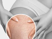 महागडे क्रिम्स वापरुनही स्ट्रेच मार्क जात नाहीत? करा ३ घरगुती उपाय- १ पैशाचा खर्च नाही - Marathi News | Stretch marks not going away even after using expensive creams? Try these 3 home remedies - not costing a single penny | Latest sakhi Photos at Lokmat.com