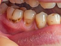 Dental Care: टार्टर आणि प्लाक दातांचे मुख्य शत्रू, करू शकतात गंभीर नुकसान; वेळीच घ्या 'ही' काळजी - Marathi News | Dental Care: Tartar and plaque are the main enemies of teeth, they can cause serious damage; Take 'this' care on time | Latest sakhi News at Lokmat.com Dental Care: टार्टर आणि प्लाक दातांचे मुख्य शत्रू, करू शकतात गंभीर नुकसान; वेळीच घ्या 'ही' काळजी - Marathi News | Dental Care: Tartar and plaque are the main enemies of teeth, they can cause serious damage; Take 'this' care on time | Latest sakhi News at Lokmat.com