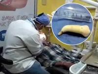 अबब! विद्यार्थ्याच्या तोंडातून काढला जगातील सर्वात मोठा दात; लांबी पाहून डॉक्टरही झाले चकीत - Marathi News | The world's largest teeth extracted from a student's mouth; Even the doctors shocked pnm | Latest jarahatke Photos at Lokmat.com