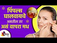 चेहऱ्यावरील पिंपल्ससाठी मधाचा घरगुती रामबाण उपाय | Benefits of Honey for pimples | Pimples Remover