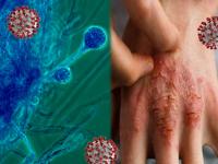 चिंताजनक! कोरोनाच्या संकटात आता फंगल इन्फेक्शनचा वाढतोय धोका; जाणून घ्या लक्षणं - Marathi News | Black fungus infection in india covid-19 connection with mucormycosis disease | Latest health Photos at Lokmat.com