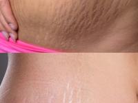 Remedies for stretch marks : लूक बिघडवणारे स्ट्रेच मार्क्स कायमचे होतील दूर; महागड्या क्रिम्स नाही, करा फक्त ५ घरगुती उपाय - Marathi News | Remedies for stretch marks : How to Get Rid of Stretch Marks : 5 best ways to remove stretch marks from stomach | Latest sakhi Photos at Lokmat.com