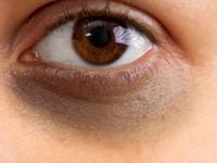 Dark Circles Solution : डोळ्यांखालच्या काळ्या वर्तुळांनी लूक बिघडवलाय? १० उपाय, गायब होतील डार्क सर्कल्स - Marathi News | Dark Circles Solution : Home remedies for dark circles easy ways to get rid of dark circles | Latest sakhi Photos at Lokmat.com