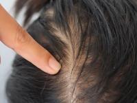 केसांच्या ५ तक्रारी सांगतात तुमच्या बिघडलेल्या तब्येतीची लक्षणं, दुर्लक्ष करणं पडतं महागात - Marathi News | 5 hair problems can be the symptoms of your poor health and indicates several internal health issues | Latest sakhi Photos at Lokmat.com