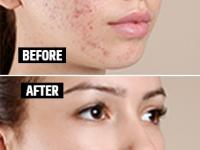 How To Remove Pimples Spots : पिंपल्समुळे चेहऱ्यावर काळे डाग, खड्डे पडलेत? ३ उपाय, चेहरा दिसेल ग्लोईंग डागविरहीत - Marathi News | How To Remove Pimples Spots : Due to pimples, black spots, pits on the face? 3 solutions, the face will look glowing | Latest sakhi Photos at Lokmat.com