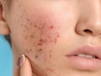 पिंपल्स, ॲक्ने यामुळे हैराण? बघा तज्ज्ञ सांगत आहेत ५ जबरदस्त उपाय - Marathi News | 5 super solutions given by Rujuta Divekar for reducing pimples and acne | Latest sakhi Photos at Lokmat.com