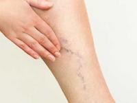 व्हेरिकोज व्हेन्सचा त्रास होतो? ५ व्यायाम करा, दुखणं कमी होऊन मिळेल आराम - Marathi News | Suffering from varicose veins? Do 5 exercises, the pain will decrease and you will get relief | Latest sakhi Photos at Lokmat.com