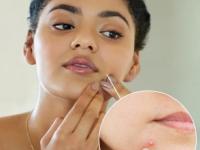 चेहऱ्यावर प्रचंड पिंपल्स आलेत? ४ सोपे उपाय, पिंपल्स होतील कमी आणि चेहरा सुंदर - Marathi News | Having pimples on your face? 4 simple solutions, pimples will be less and face will become beautiful | Latest sakhi Photos at Lokmat.com