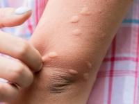 उकाडा वाढला, घरात फार डास झालेत? ७ उपाय - डासांचा उपद्रव होईल कमी - Marathi News | How to get rid of mosquitoes inside the house | Latest sakhi Photos at Lokmat.com