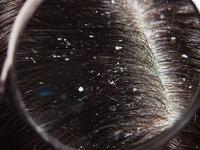 पावसाळ्यात केसांमध्ये कोंडा झाला? ४ टिप्स, केस गळती थांबेल, स्काल्पमधील कोंडा-पुळ्या दूर - Marathi News | Home Remedies to Get Rid of Dandruff Naturally : Dandruff Treatments and Remedies | Latest sakhi Photos at Lokmat.com