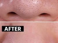 ब्लॅकहेड्समुळे नाक खूपच खरखरीत दिसते? ४ सोपे उपाय, नाकावरची त्वचा होईल स्वच्छ- मऊ - Marathi News | DIY: 4 Best home remedies to remove blackheads, How to get rid of blackheads whiteheads | Latest sakhi Photos at Lokmat.com