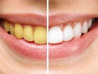 पिवळट दात पांढरेशुभ्र होऊन मोत्यासारखे लख्ख चमकतील- बघा केळीच्या सालींचा खास उपयोग - Marathi News | Use of banana peel to whiten your teeth, home remedies for yellow teeth, how to make teeth white, how to get rid of yellow teeth? | Latest sakhi Photos at Lokmat.com