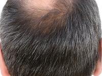 केस गळताहेत-हळू हळू टक्कल पडतंय? किचनमधले ५ पदार्थ केसांना लावा-लांबसडक दाट होतील केस - Marathi News | Hair Growth Tips : How to Grow Hairs Using Home remedies Use These Kitchen ingredients For Weight Gain | Latest sakhi Photos at Lokmat.com