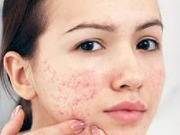 काही मिनिटांतच पिंपल्स दबून जातील, स्वयंपाक घरातले ३ पदार्थ वापरून करा आयुर्वेदिक उपाय - Marathi News | Ayurvedic remedies for removing pimples and getting clear skin, how to get rid of pimples, home remedies for pimples, Banish Pimples with Ayurveda, Natural & Quick Solutions for Clear Skin | Latest sakhi Photos at Lokmat.com