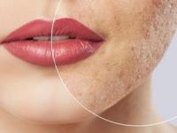 उन्हाळ्यात घाम येऊन चेहरा जास्तच ऑईली- चिपचिपित होतो? मुलतानी मातीसोबत लावा 'हे' ३ पदार्थ - Marathi News | Home remedies for oily skin in summer, how to keep skin glowing in summer, how to apply multani mitti on face | Latest sakhi Photos at Lokmat.com