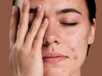 उष्णतेमुळे चेहऱ्यावर सतत पिंपल्स येतात? ५ पदार्थ खाणं सोडा, पुळ्या-डाग दिसणार नाहीत - Marathi News | How To Get Rid Pimples : Pimples Remove pimples From Face Health Tips Face Cleaning Tips | Latest sakhi Photos at Lokmat.com