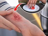 उन्हाळ्यात स्वयंपाक करताना चटका बसल्यावर खूपच आग होते? ३ टिप्स लक्षात ठेवा, आग होईल चटकन कमी - Marathi News | what to do immediately after cooking burn, 3 remedies for treating cooking burn | Latest sakhi Photos at Lokmat.com