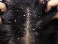 काही केल्या डोक्यातला कोंडा कमी होत नाही? जावेद हबीब सांगतात १५ दिवसांत कोंडा घालविण्याचा उपाय - Marathi News | best home remedy for reducing dandruff, javed habib's expert solution for dandruff, how to get rid of severe dandruff problem | Latest sakhi Photos at Lokmat.com