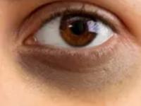 डोळ्यांभोवती काळी वर्तुळं येण्याची ३ मुख्य कारणं आणि उपाय! डार्क सर्कल्सला करा बाय बाय - Marathi News | 3 major reasons for dark circles, how to reduce dark circles, home remedies to get rid of dark circles | Latest sakhi Photos at Lokmat.com