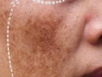 पिग्मेंटेशन-डागांमुळे चेहरा वयस्कर दिसतो? किचनमधल्या २ गोष्टी लावा; चेहऱ्यावर येईल तेज - Marathi News | Pigmentation On Face Treatment At Home Using Curd And Cucumber | Latest sakhi Photos at Lokmat.com