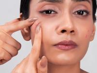 चेहऱ्यावर सारखे पिंपल्स येत असतील तर सगळ्यात आधी 'हे' काम करा, काही दिवसांतच पिंपल्स गायब... - Marathi News | best home remedies to get rid of pimples, how to reduce pimples, beauty tips for pimples | Latest sakhi Photos at Lokmat.com