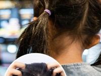 केसांत कोंडा झाल्यामुळे मुलं सारखं डोकं खाजवतात? जावेद हबीब सांगतात सोपा उपाय- कोंडा गायब - Marathi News | best home remedy for dandruff in kids hair by javed habib, how to prevent dandruff in kids hair | Latest sakhi Photos at Lokmat.com