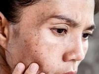 चेहऱ्यावरचे वांगाचे डाग घालविणारा सगळ्यात सोपा उपाय! ज्येष्ठमधाचा करा वापर- चेहरा होईल नितळ, सुंदर - Marathi News | best home remedy to reduce pigmentation, how to reduce pigmentation and tanning, use of mulethi for clear and radiant glowing skin | Latest sakhi Photos at Lokmat.com