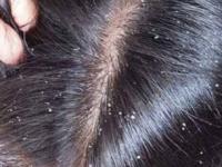 डोक्यात खूपच कोंडा झाला? करा सोपा उपाय, ८ दिवसांत कोंडा गायब आणि केस होतील चमकदार - Marathi News | best home remedies for removing dandruff, how to get rid of dandruff, how to use Fenugreek seeds for controlling dandruff in hair | Latest sakhi Photos at Lokmat.com