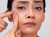 नेहमीच खूप पिंपल्स येतात? 'हा' पदार्थ खाणं बंद करा- ८ दिवसांत पिंपल्स जातील - Marathi News | how to get rid of pimple, simple tips and tricks to get rid of pimples, best home remedies for pimples | Latest sakhi Photos at Lokmat.com