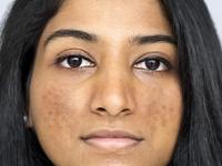 वांगाच्या डागांमुळे चेहरा खराब दिसू लागला? ३ फळं चेहऱ्याला लावा, काही दिवसांतच डाग गायब - Marathi News | 3 fruit face pack for reducing pigmentation on skin, how to get rid of pigmented skin, simple and easy way for reducing pigmentation | Latest sakhi Photos at Lokmat.com